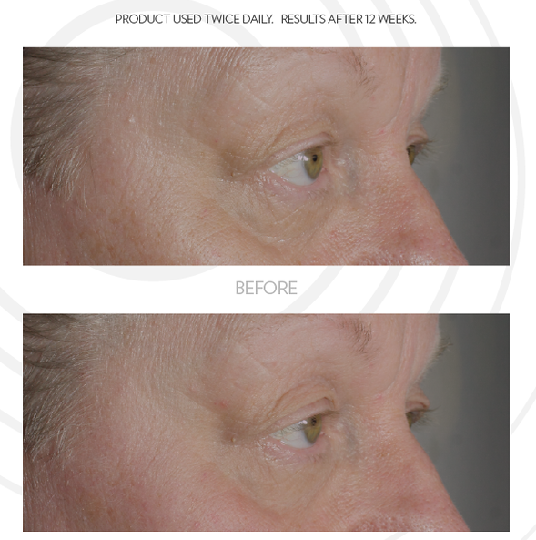 ageloc iealeyes cream for accent before and after