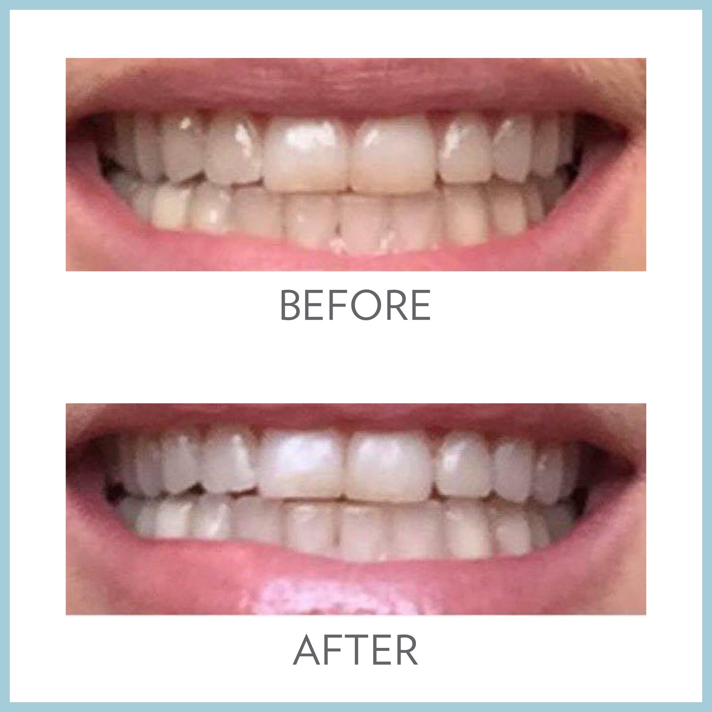 AP 24 Whitening Fluoride Toothpaste Before After