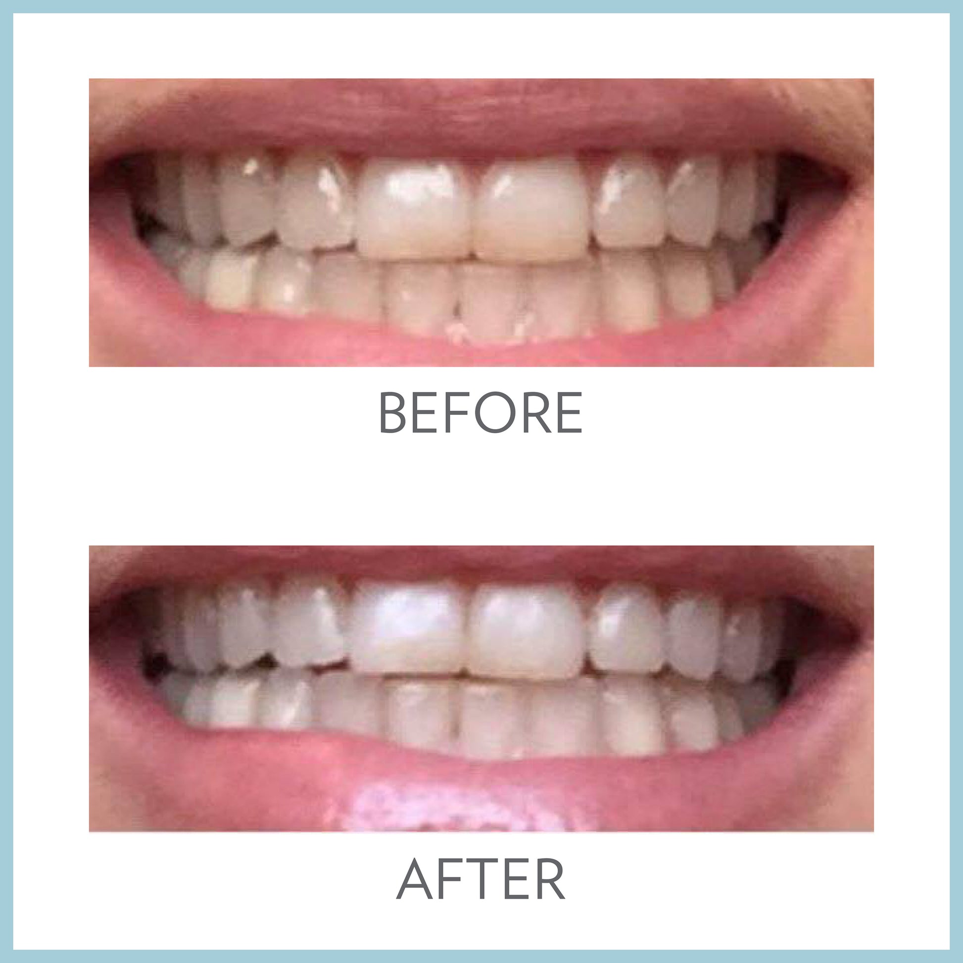 AP 24 Whitening Fluoride Toothpaste Before After