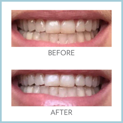 AP 24 Whitening Fluoride Toothpaste Before After