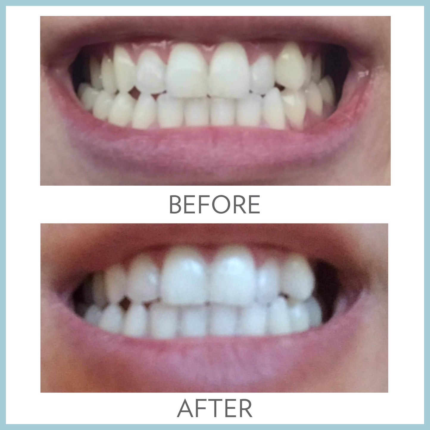 AP 24 Whitening Fluoride Toothpaste Before and After