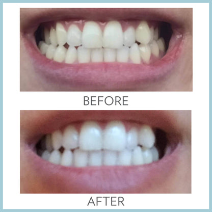 AP 24 Whitening Fluoride Toothpaste Before and After