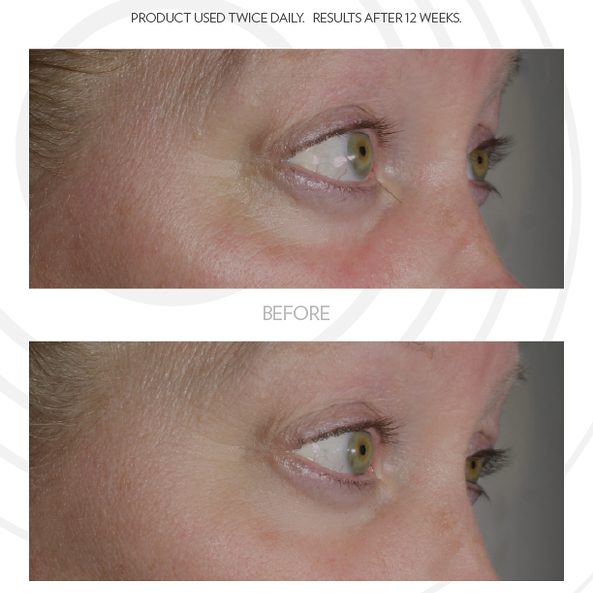 ageloc iealeyes cream for accent  before and after