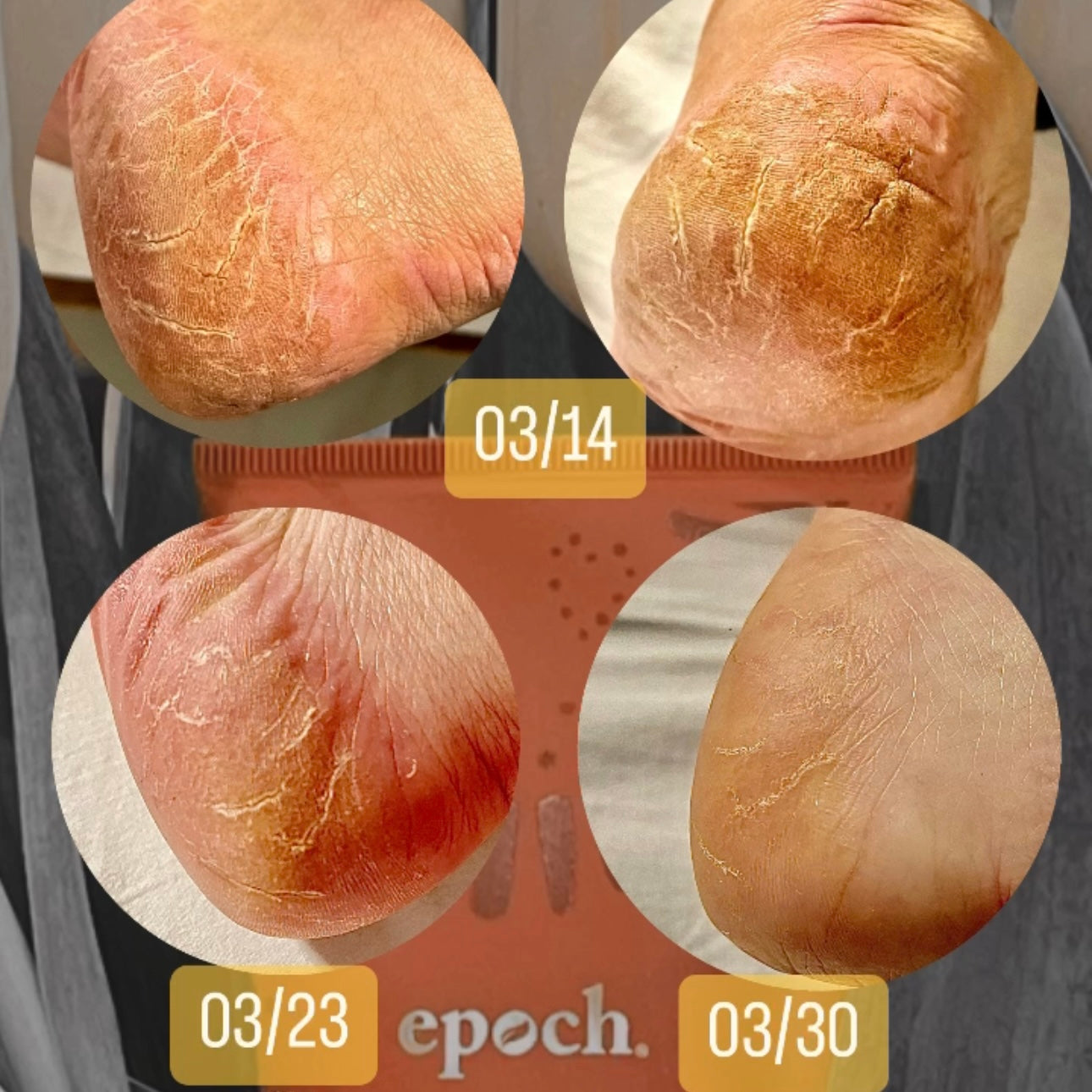 epoch sole treatment01 before and after